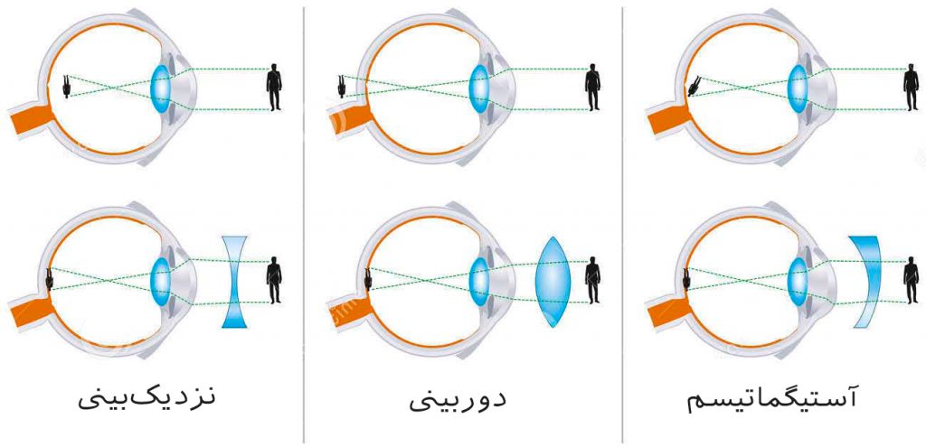 آستیگماتیسم – ساپیبا