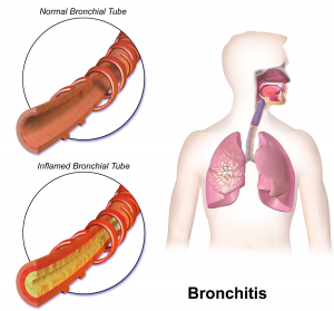 برونشیت حاد (Acute Bronchitis) – sapiba