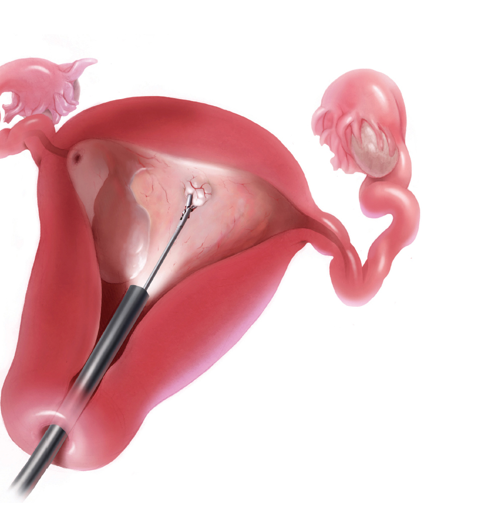 Гистерорезектоскопия удаление матки