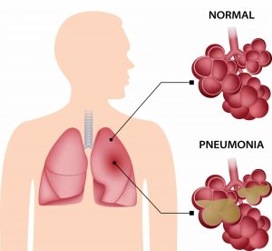 عفونت ریه (پنومونی) (Pneumonia) – sapiba
